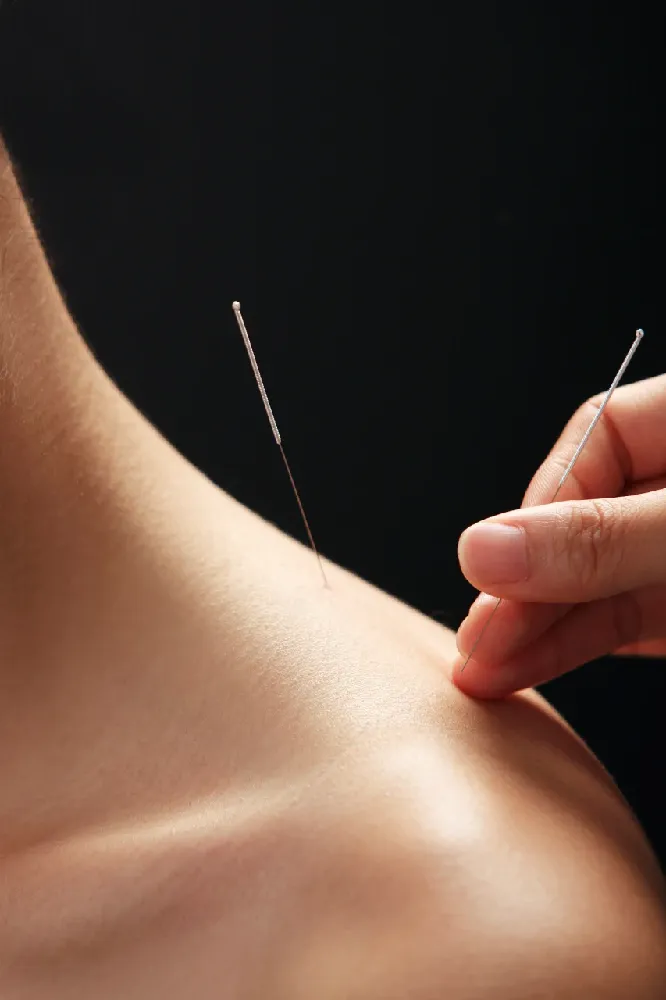 Acupuncture Weight Loss: A Non-Diet Approach to Lose Weight